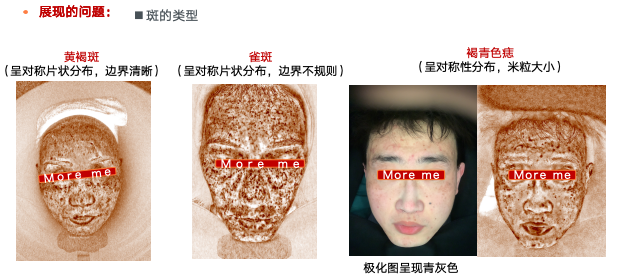 面部雀斑检测再升级！艾摩米新专利展现AI智能皮肤检测新高度